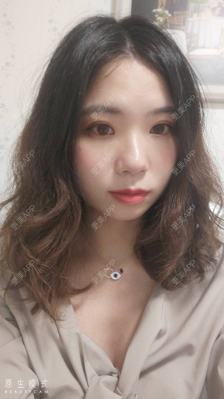 更美 - 墨七轩的双眼皮经验 | 双眼皮 | 全切双眼皮 | 开内眼角 | 开外眼角 | 杭州