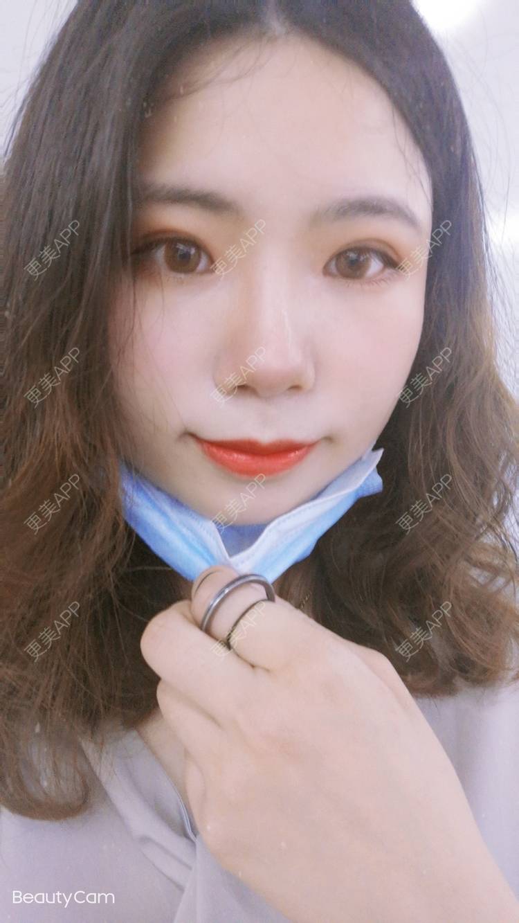 更美 - 墨七轩的双眼皮经验 | 双眼皮 | 全切双眼皮 | 开内眼角 | 开外眼角 | 杭州