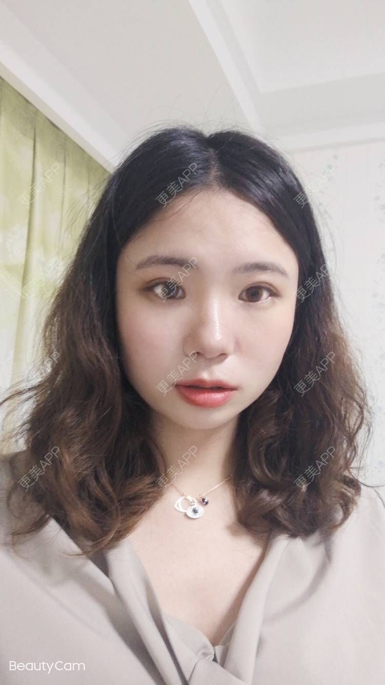 更美 - 墨七轩的双眼皮经验 | 双眼皮 | 全切双眼皮 | 开内眼角 | 开外眼角 | 杭州