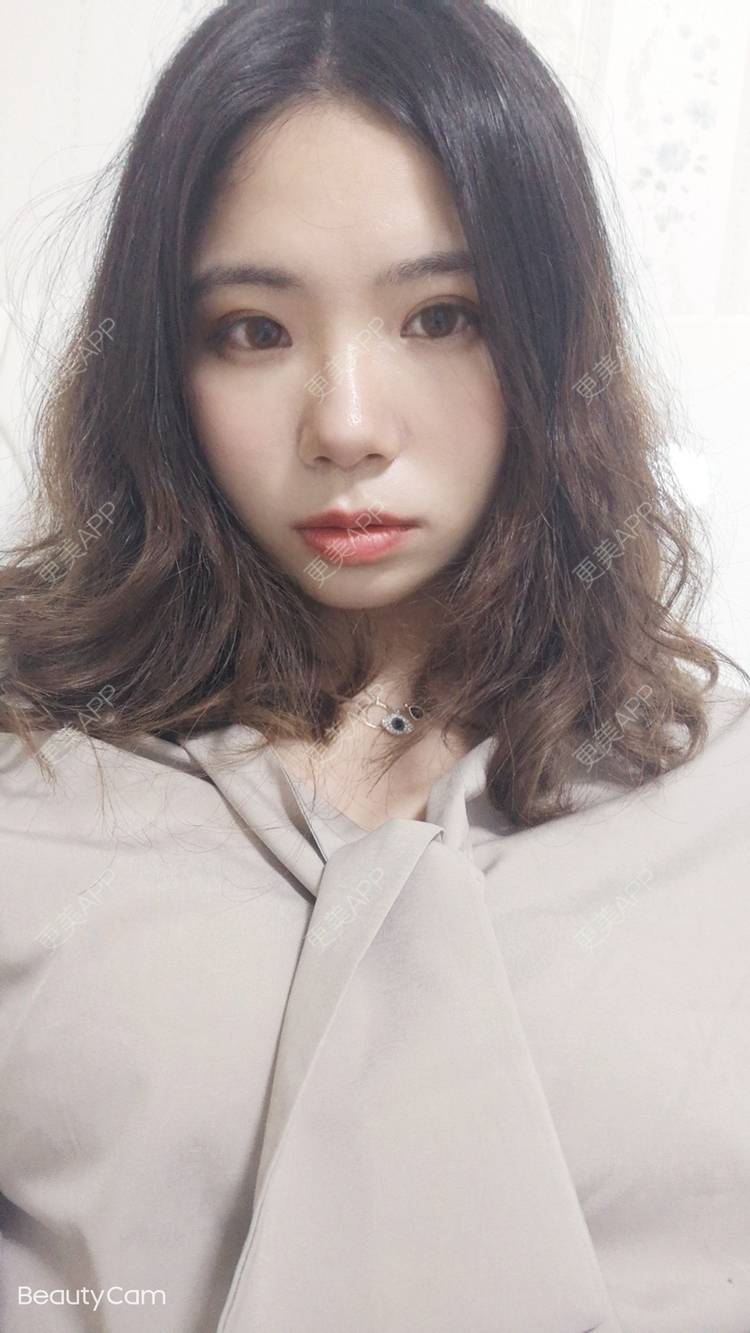 更美 - 墨七轩的双眼皮经验 | 双眼皮 | 全切双眼皮 | 开内眼角 | 开外眼角 | 杭州