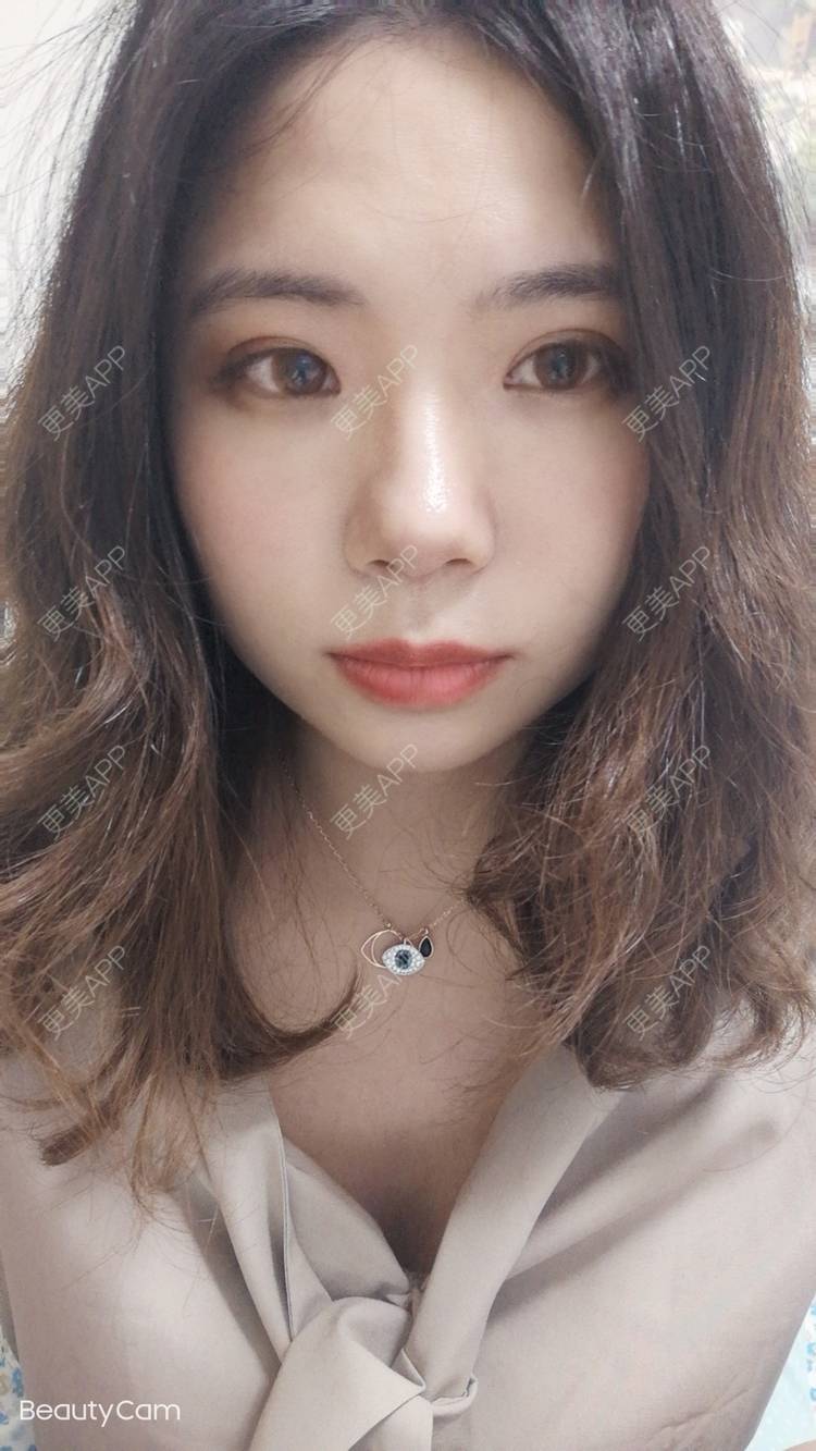 更美 - 墨七轩的双眼皮经验 | 双眼皮 | 全切双眼皮 | 开内眼角 | 开外眼角 | 杭州