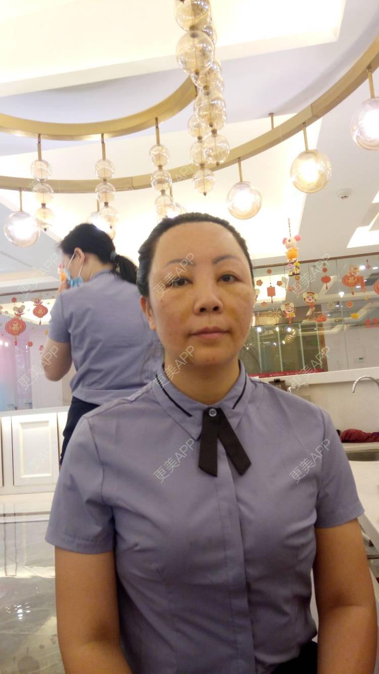 更美 - 更美用户u3zFY6hL8g的自体脂肪全面部填充经验 | 视频日记 | 深圳 | 自体脂肪全面部填充