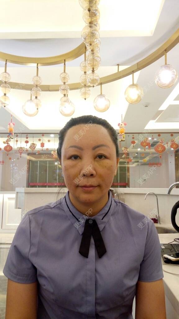 更美 - 更美用户u3zFY6hL8g的自体脂肪全面部填充经验 | 视频日记 | 深圳 | 自体脂肪全面部填充