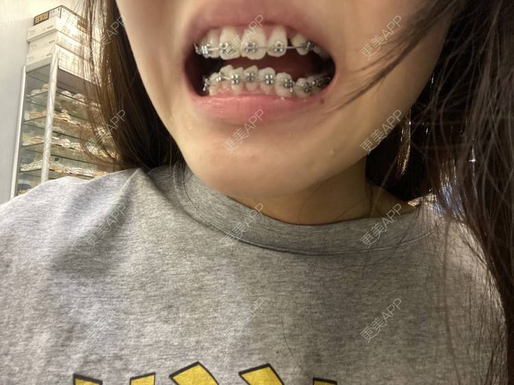 更美 - 更美用户n8XFkCxH2q的金属托槽矫正经验 | 上海