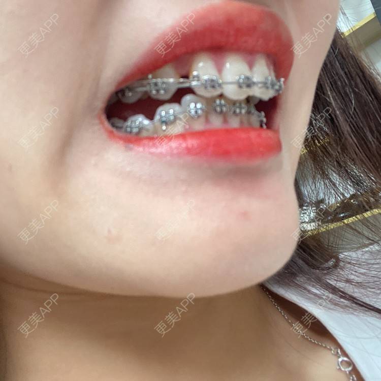 更美 - 更美用户n8XFkCxH2q的金属托槽矫正经验 | 上海