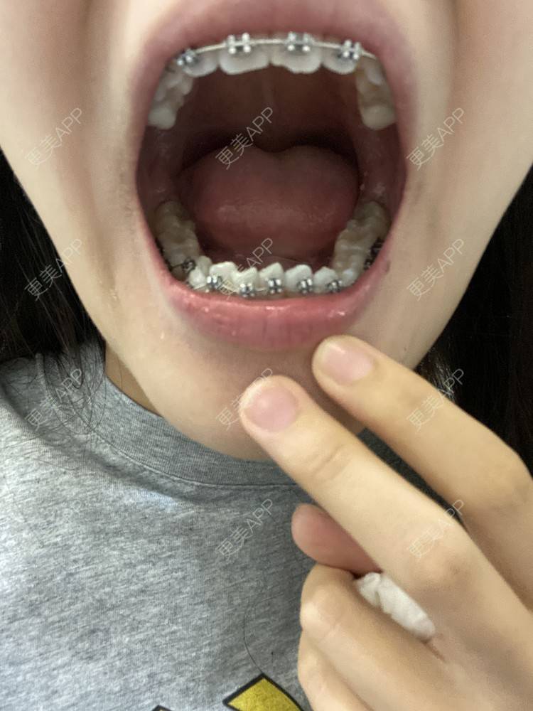 更美 - 更美用户n8XFkCxH2q的金属托槽矫正经验 | 上海