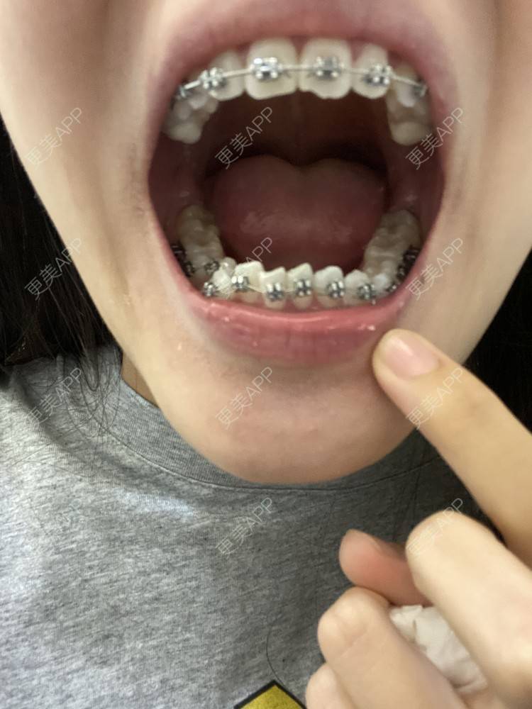 更美 - 更美用户n8XFkCxH2q的金属托槽矫正经验 | 上海