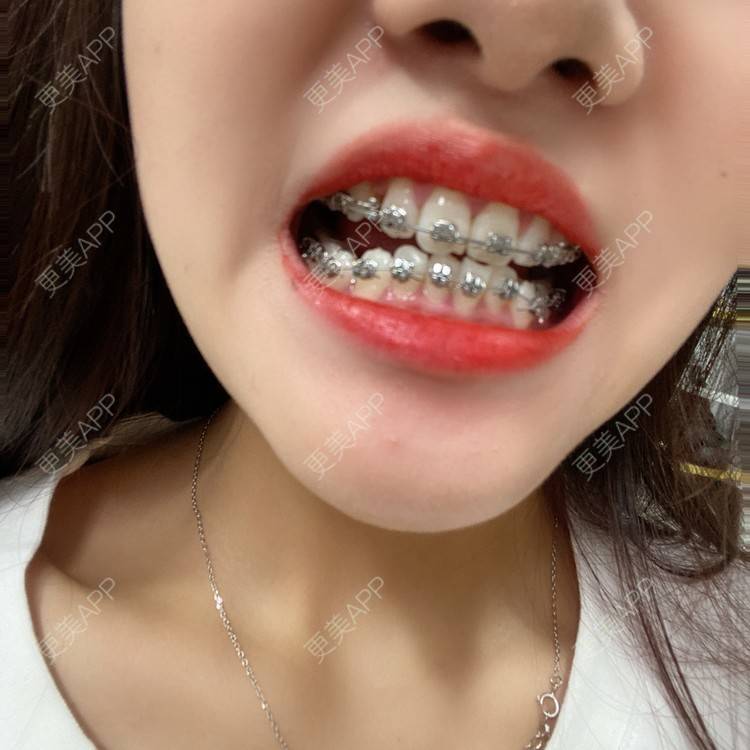 更美 - 更美用户n8XFkCxH2q的金属托槽矫正经验 | 上海