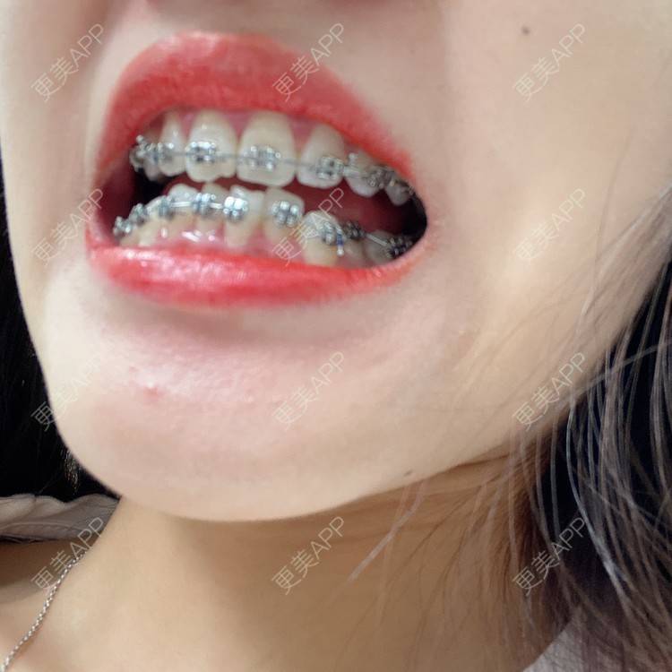 更美 - 更美用户n8XFkCxH2q的金属托槽矫正经验 | 上海