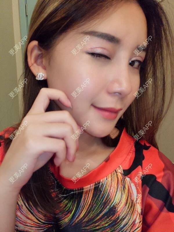 更美 - Imiss you的宽下巴矫正经验 | 玻尿酸下巴 | 下巴截骨前移 | 硅胶垫下巴 | 膨体垫下巴 | 宽下巴矫正 | 自体脂肪丰太阳穴 | 硅胶丰太阳穴 | 膨体丰太阳穴 | 人工骨垫下巴 | 成都