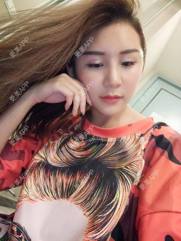 更美 - Imiss you的宽下巴矫正经验 | 玻尿酸下巴 | 下巴截骨前移 | 硅胶垫下巴 | 膨体垫下巴 | 宽下巴矫正 | 自体脂肪丰太阳穴 | 硅胶丰太阳穴 | 膨体丰太阳穴 | 人工骨垫下巴 | 成都