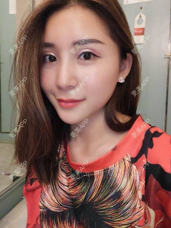 更美 - Imiss you的宽下巴矫正经验 | 玻尿酸下巴 | 下巴截骨前移 | 硅胶垫下巴 | 膨体垫下巴 | 宽下巴矫正 | 自体脂肪丰太阳穴 | 硅胶丰太阳穴 | 膨体丰太阳穴 | 人工骨垫下巴 | 成都