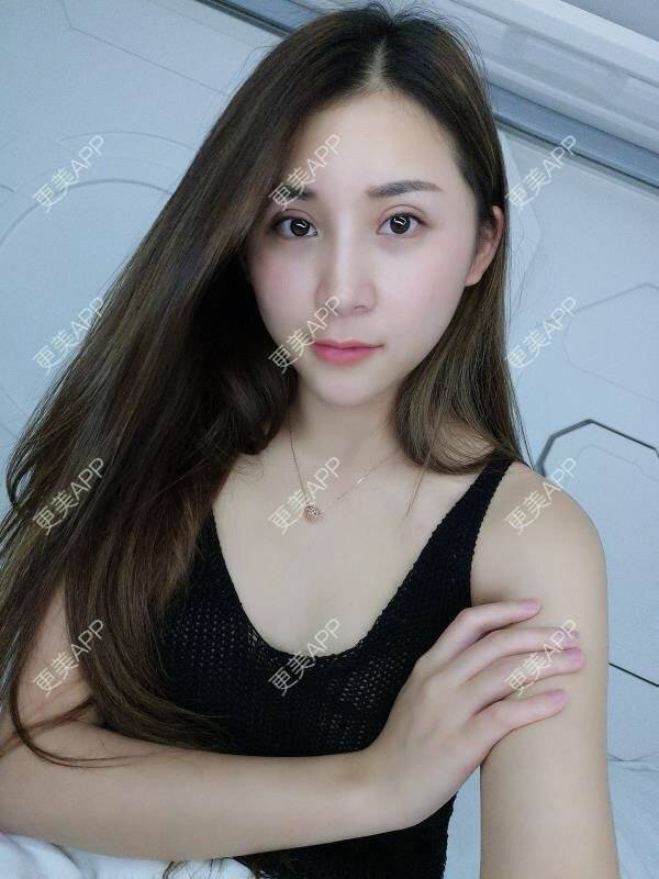 更美 - Imiss you的宽下巴矫正经验 | 玻尿酸下巴 | 下巴截骨前移 | 硅胶垫下巴 | 膨体垫下巴 | 宽下巴矫正 | 自体脂肪丰太阳穴 | 硅胶丰太阳穴 | 膨体丰太阳穴 | 人工骨垫下巴 | 成都