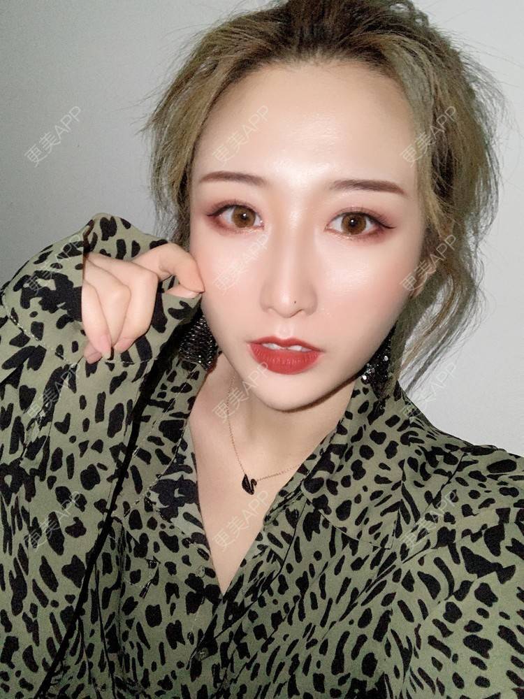 更美 - 更美用户KtaWOoiEh5的埋线提升经验 | 埋线提升 | 东莞