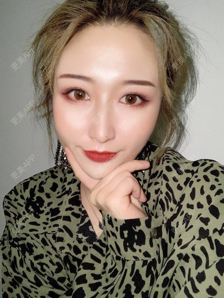 更美 - 更美用户KtaWOoiEh5的埋线提升经验 | 埋线提升 | 东莞