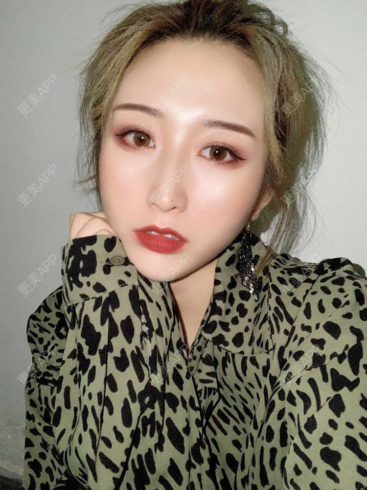 更美 - 更美用户KtaWOoiEh5的埋线提升经验 | 埋线提升 | 东莞