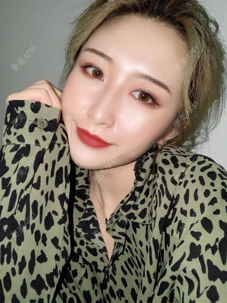 更美 - 更美用户KtaWOoiEh5的埋线提升经验 | 埋线提升 | 东莞