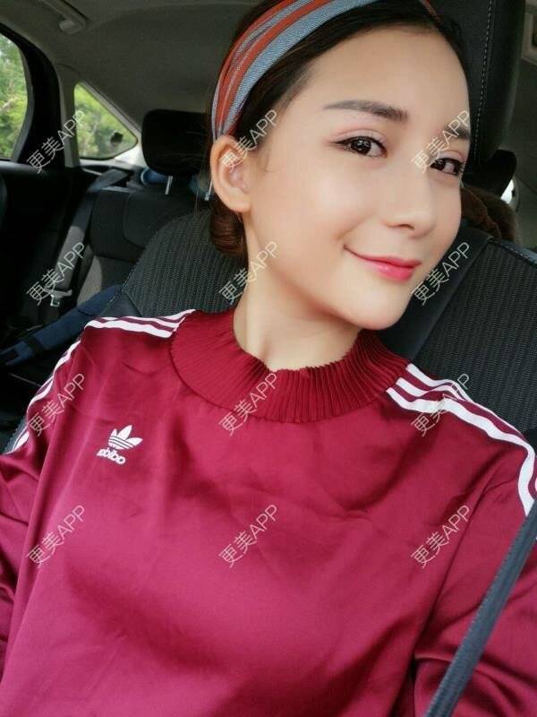 更美 - Imiss you的宽下巴矫正经验 | 膨体垫下巴 | 硅胶垫下巴 | 缩下巴 | 膨体丰太阳穴 | 人工骨垫下巴 | 玻尿酸下巴 | 下巴截骨前移 | 宽下巴矫正 | 自体脂肪丰太阳穴 | 硅胶丰太阳穴 | 成都