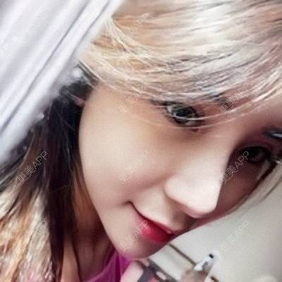 更美 - Imiss you的宽下巴矫正经验 | 膨体垫下巴 | 硅胶垫下巴 | 缩下巴 | 膨体丰太阳穴 | 人工骨垫下巴 | 玻尿酸下巴 | 下巴截骨前移 | 宽下巴矫正 | 自体脂肪丰太阳穴 | 硅胶丰太阳穴 | 成都