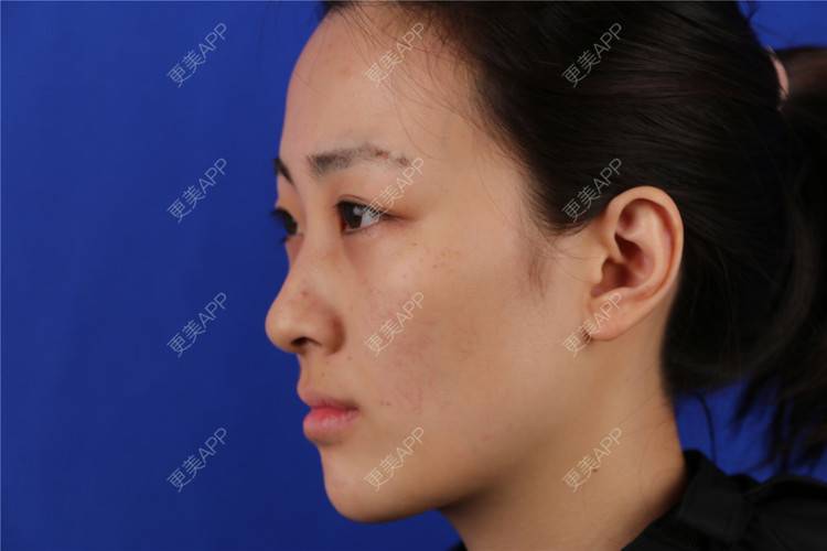 更美 - 梦离旧时光窝的激光淡化红血丝经验 | 北京 | 激光淡化红血丝