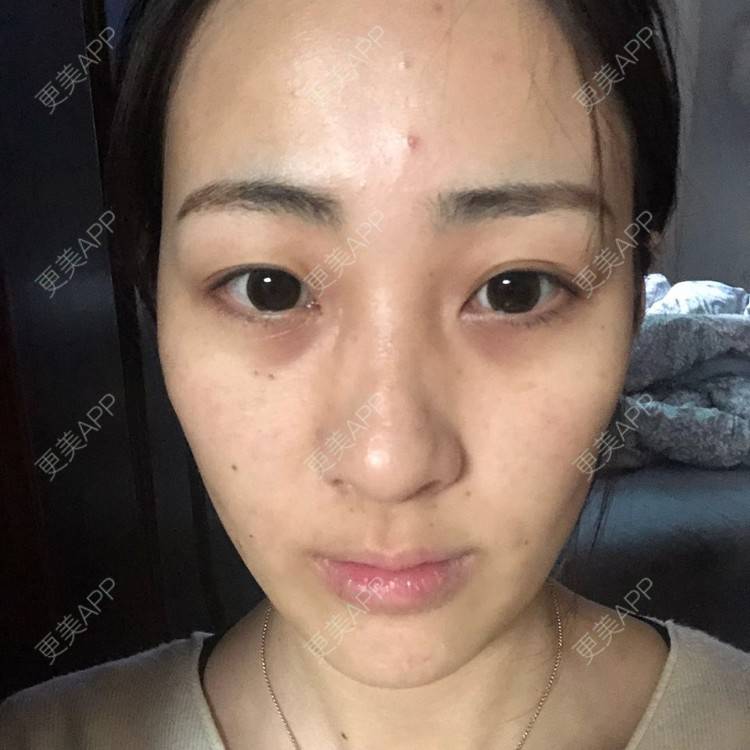 更美 - 梦离旧时光窝的激光淡化红血丝经验 | 北京 | 激光淡化红血丝