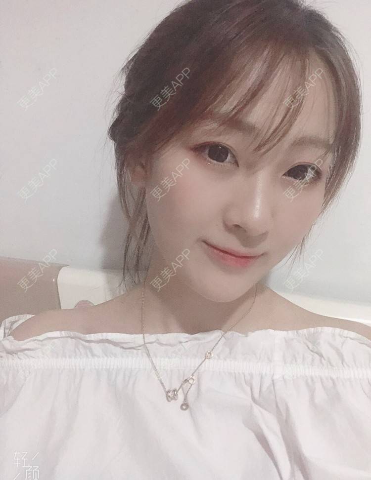 更美 - 梦离旧时光窝的激光淡化红血丝经验 | 北京 | 激光淡化红血丝