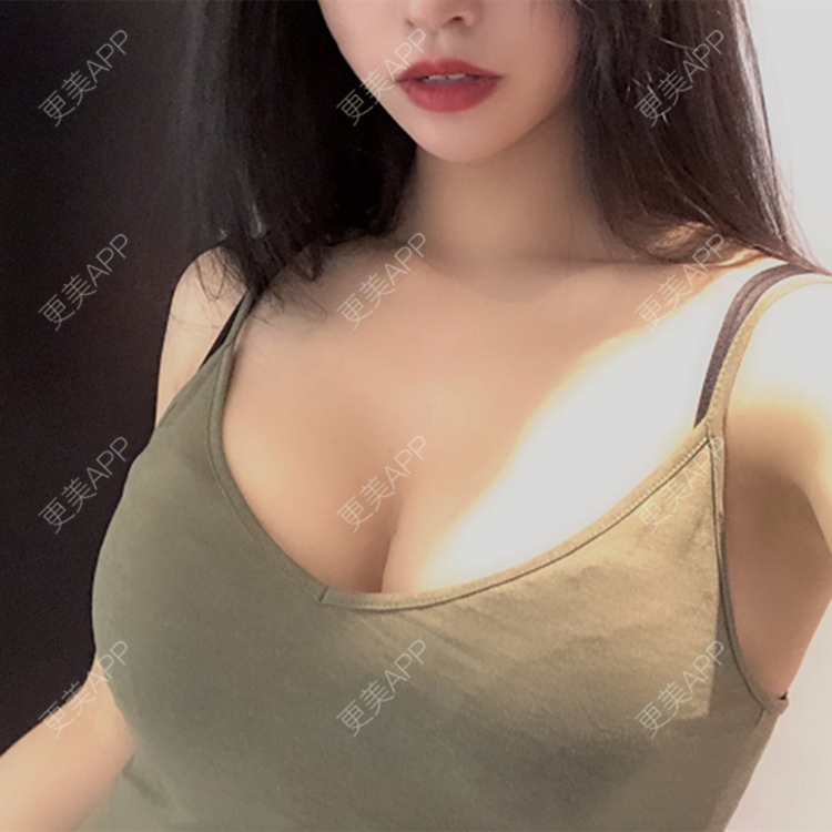 更美 - 更美用户nsazHYGRdV的假体隆胸经验 | 假体隆胸 | 青岛
