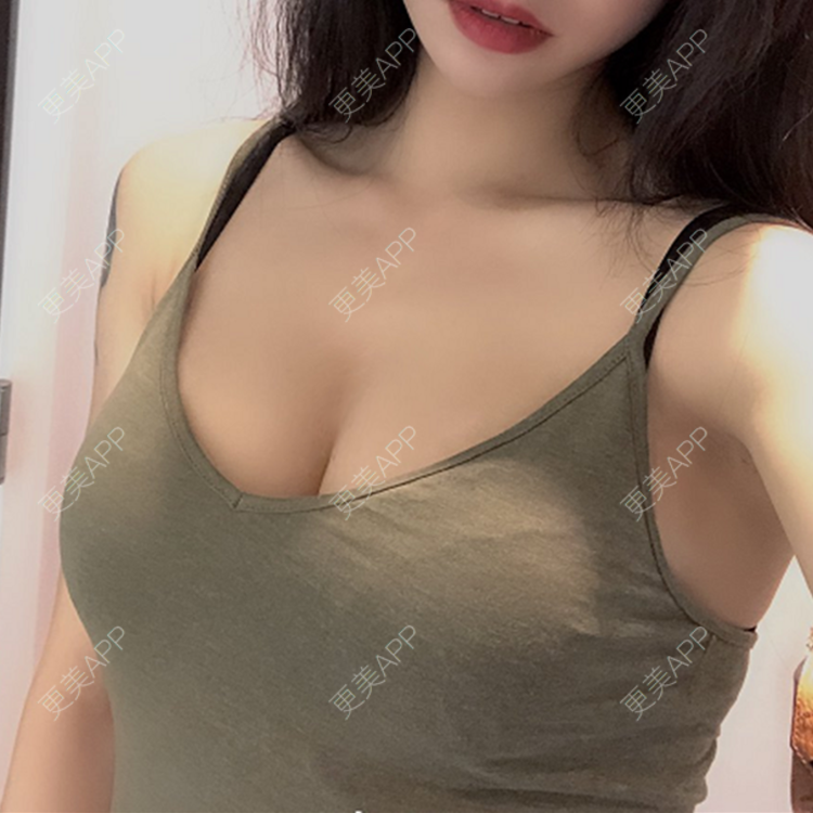 更美 - 更美用户nsazHYGRdV的假体隆胸经验 | 假体隆胸 | 青岛