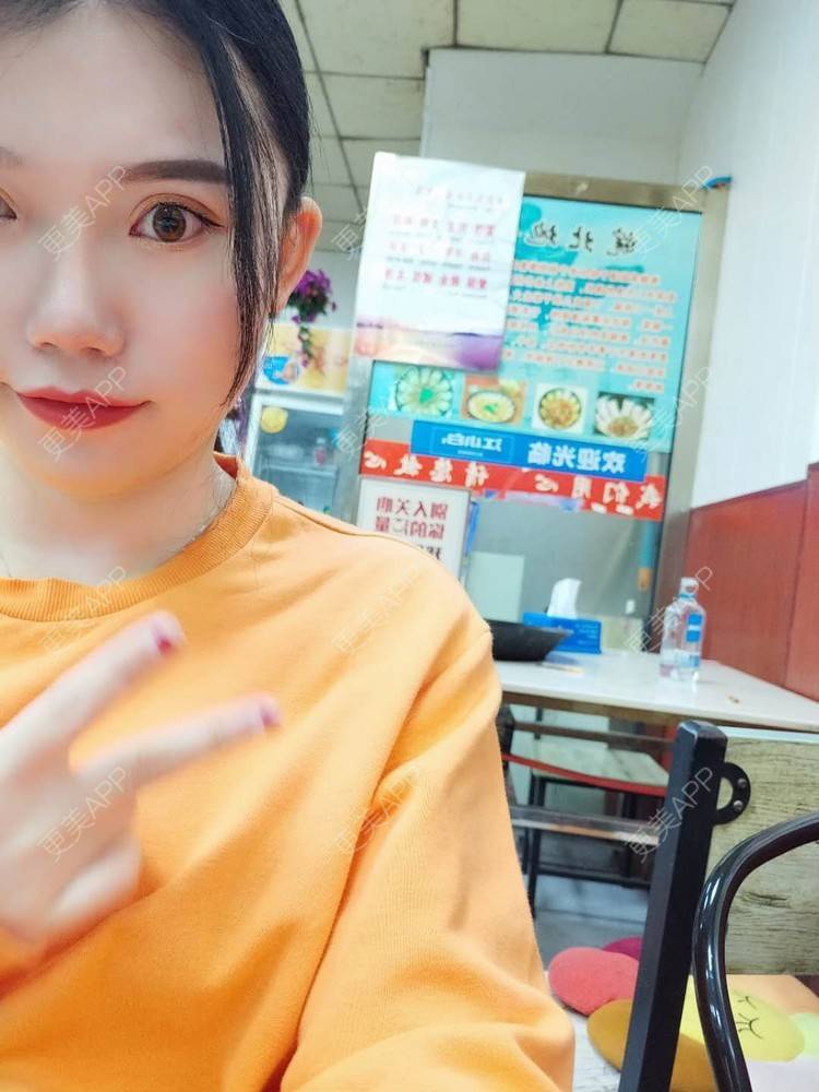 更美 - 璀璨太阳花骨朵的双眼皮修复经验 | 全切双眼皮 | 合肥 | 双眼皮修复 | 上眼睑去脂 | 开眼角修复