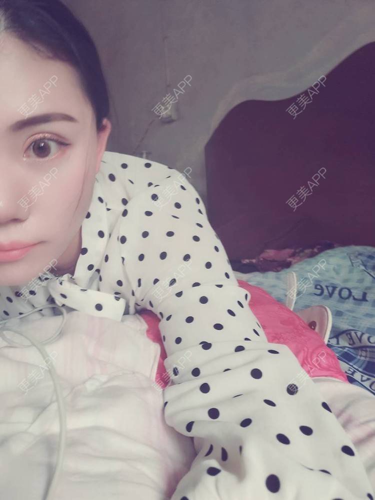 更美 - 璀璨太阳花骨朵的双眼皮修复经验 | 全切双眼皮 | 合肥 | 双眼皮修复 | 上眼睑去脂 | 开眼角修复