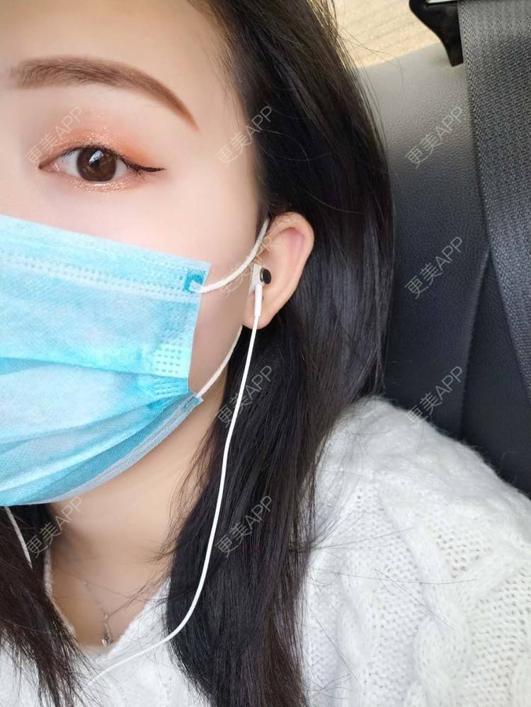 更美 - 璀璨太阳花骨朵的双眼皮修复经验 | 全切双眼皮 | 合肥 | 双眼皮修复 | 上眼睑去脂 | 开眼角修复