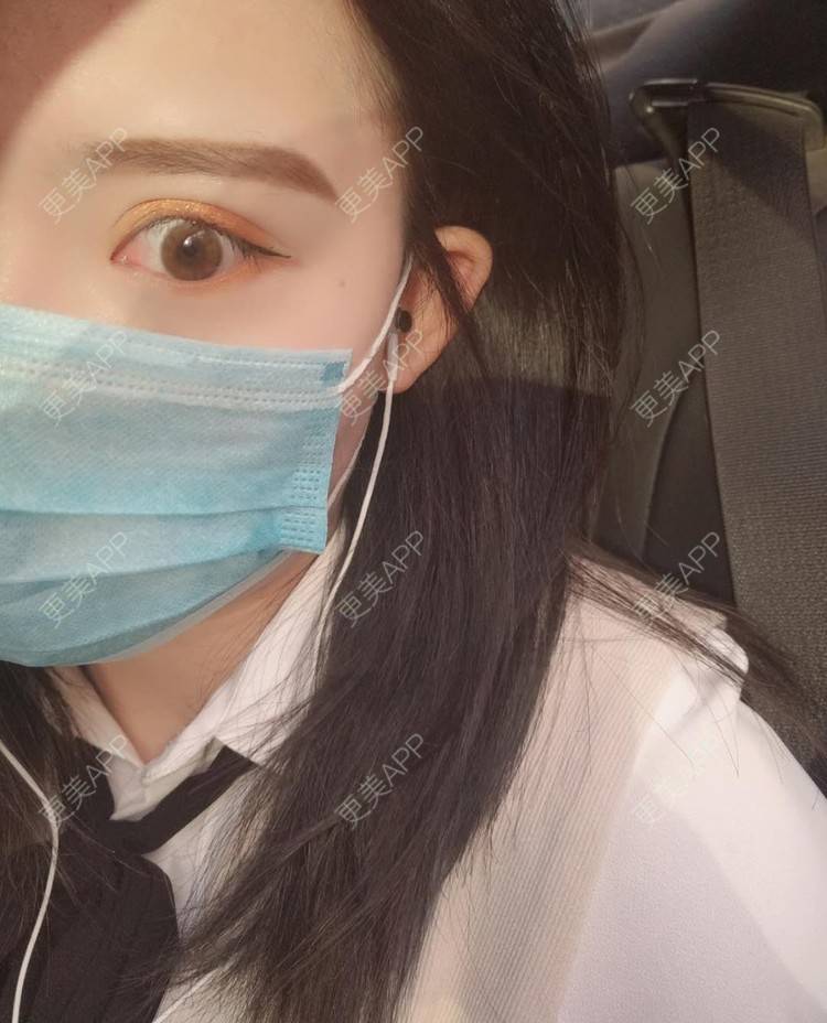 更美 - 璀璨太阳花骨朵的双眼皮修复经验 | 全切双眼皮 | 合肥 | 双眼皮修复 | 上眼睑去脂 | 开眼角修复