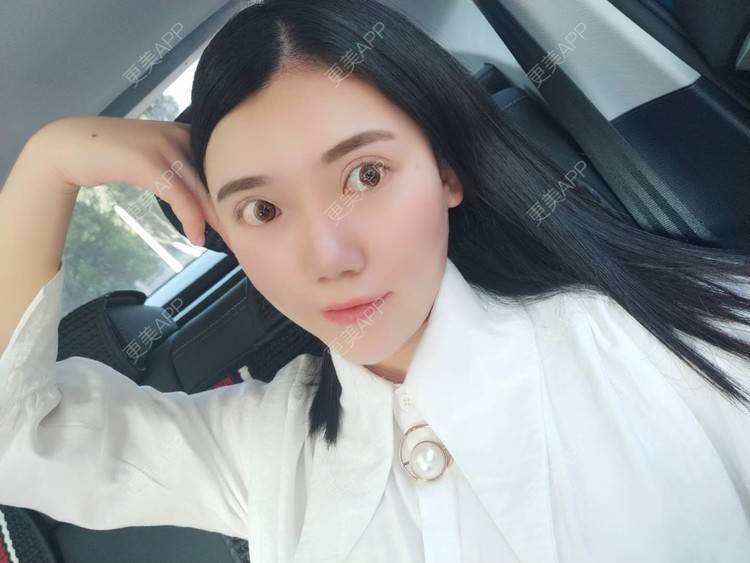更美 - 璀璨太阳花骨朵的双眼皮修复经验 | 全切双眼皮 | 合肥 | 双眼皮修复 | 上眼睑去脂 | 开眼角修复
