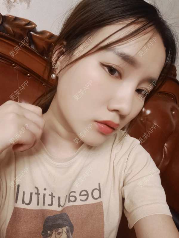 更美 - 青苔上的蜗牛的吸脂瘦脸经验 | 吸脂瘦脸 | 重庆