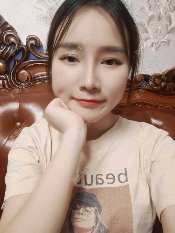 更美 - 青苔上的蜗牛的吸脂瘦脸经验 | 吸脂瘦脸 | 重庆