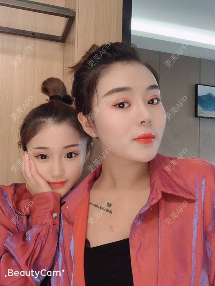更美 - 小明你好我要美美1的鼻部多项经验 | 耳软骨隆鼻 | 鼻部多项 | 广州