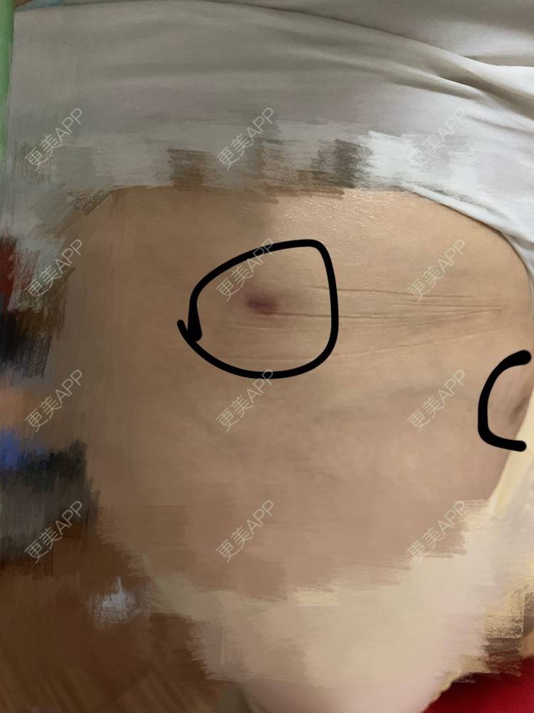 更美 - 更美用户UhNTrbf6Jt的吸脂塑臀经验 | 长沙 | 吸脂塑臀 | 热玛吉 | 超声提升