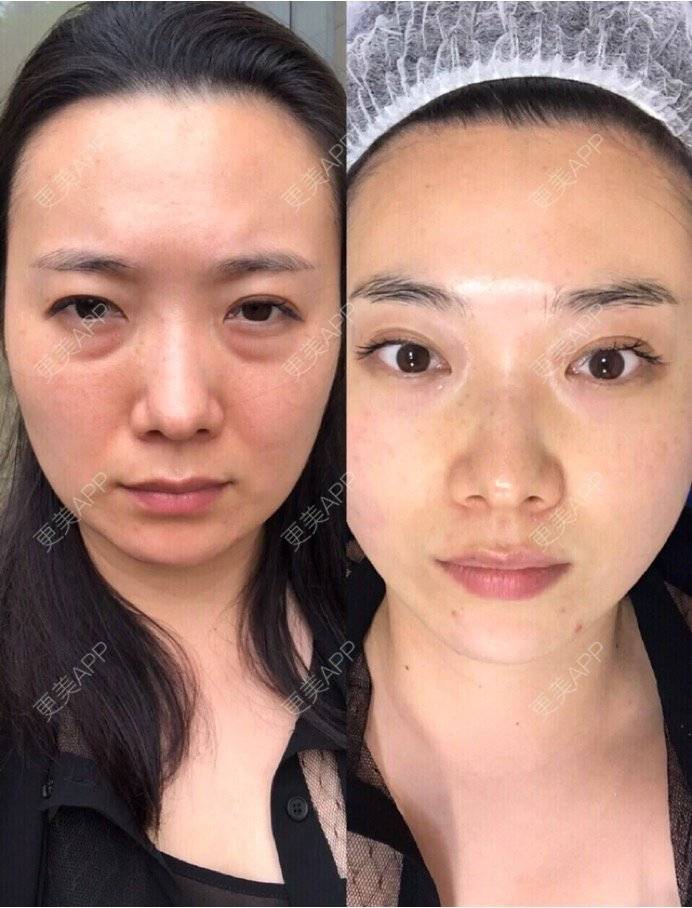 热玛吉,热玛吉前后对比照_香香儿一一热玛吉前后对比照_更美