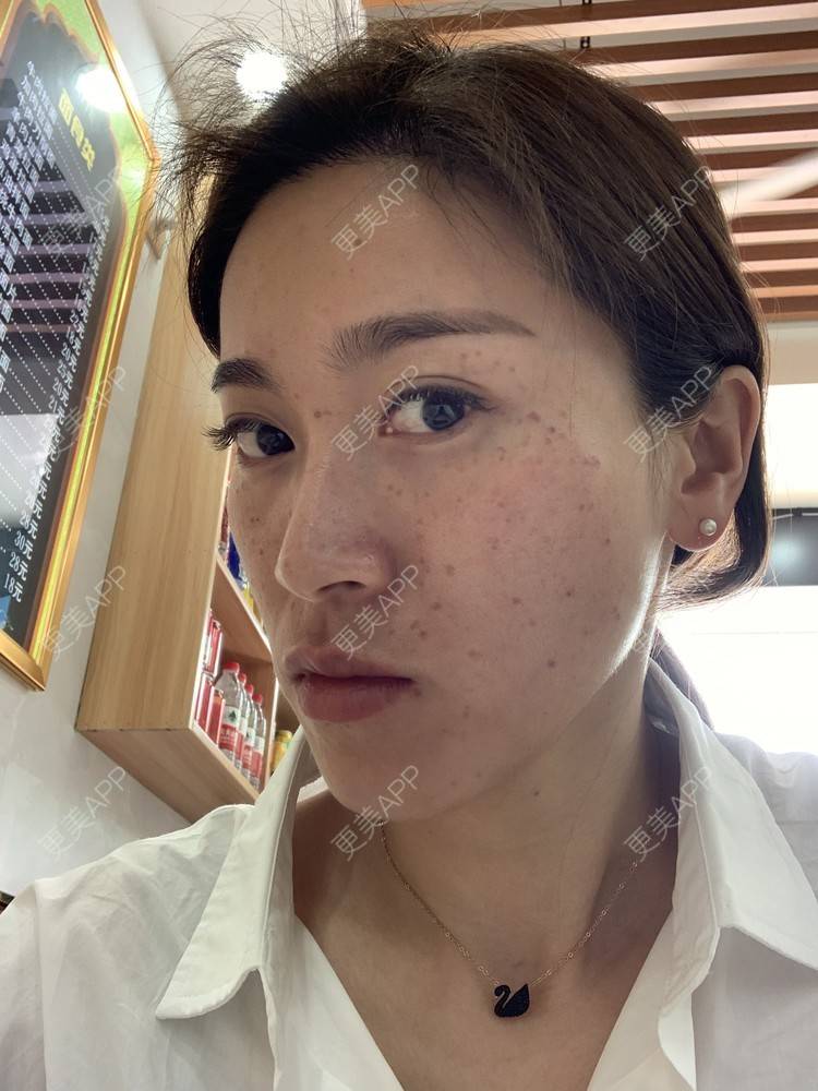 更美 - 小狐狸Vivi的皮秒激光经验 | 微针水光 | 皮秒激光 | 杭州