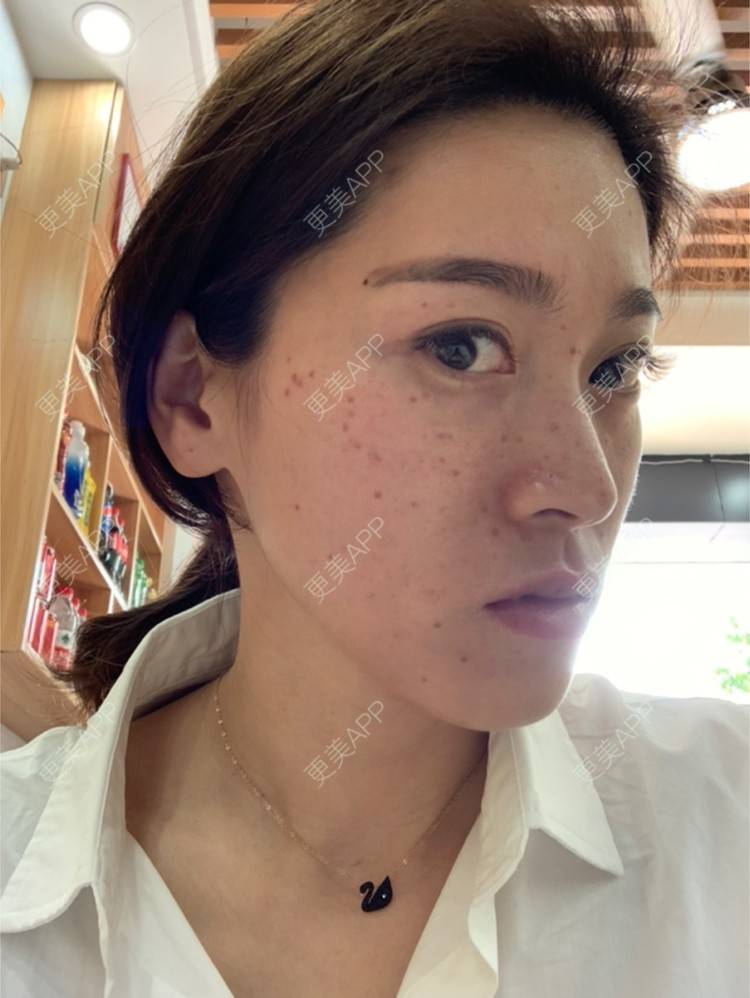 更美 - 小狐狸Vivi的皮秒激光经验 | 微针水光 | 皮秒激光 | 杭州