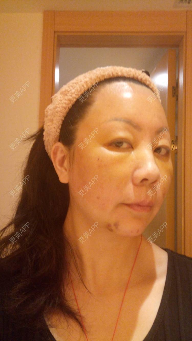 更美 - 更美用户u3zFY6hL8g的自体脂肪全面部填充经验 | 视频日记 | 深圳 | 自体脂肪全面部填充