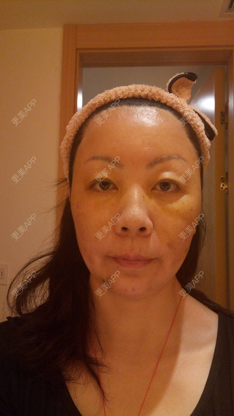 更美 - 更美用户u3zFY6hL8g的自体脂肪全面部填充经验 | 视频日记 | 深圳 | 自体脂肪全面部填充