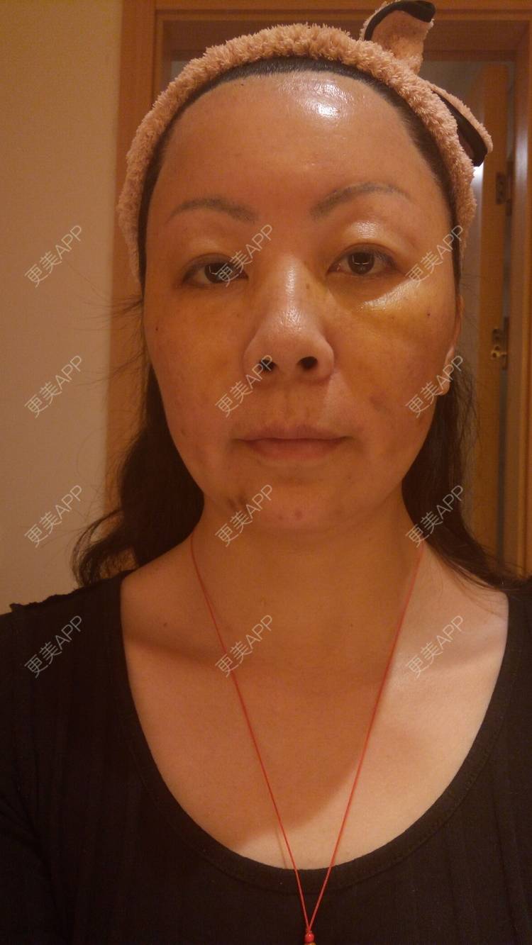 更美 - 更美用户u3zFY6hL8g的自体脂肪全面部填充经验 | 视频日记 | 深圳 | 自体脂肪全面部填充