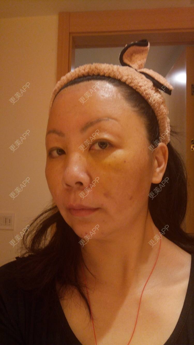 更美 - 更美用户u3zFY6hL8g的自体脂肪全面部填充经验 | 视频日记 | 深圳 | 自体脂肪全面部填充