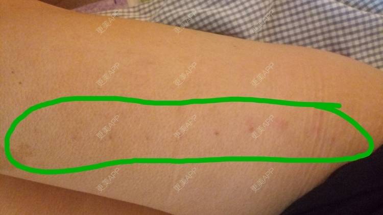 更美 - 更美用户u3zFY6hL8g的自体脂肪全面部填充经验 | 视频日记 | 深圳 | 自体脂肪全面部填充