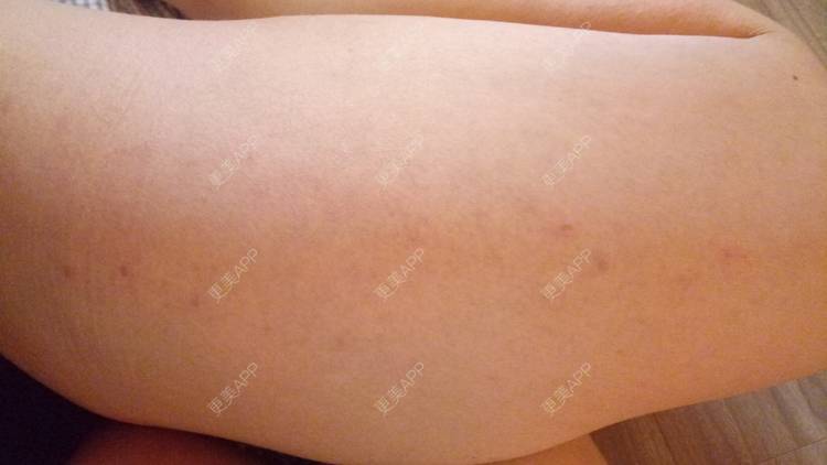 更美 - 更美用户u3zFY6hL8g的自体脂肪全面部填充经验 | 视频日记 | 深圳 | 自体脂肪全面部填充