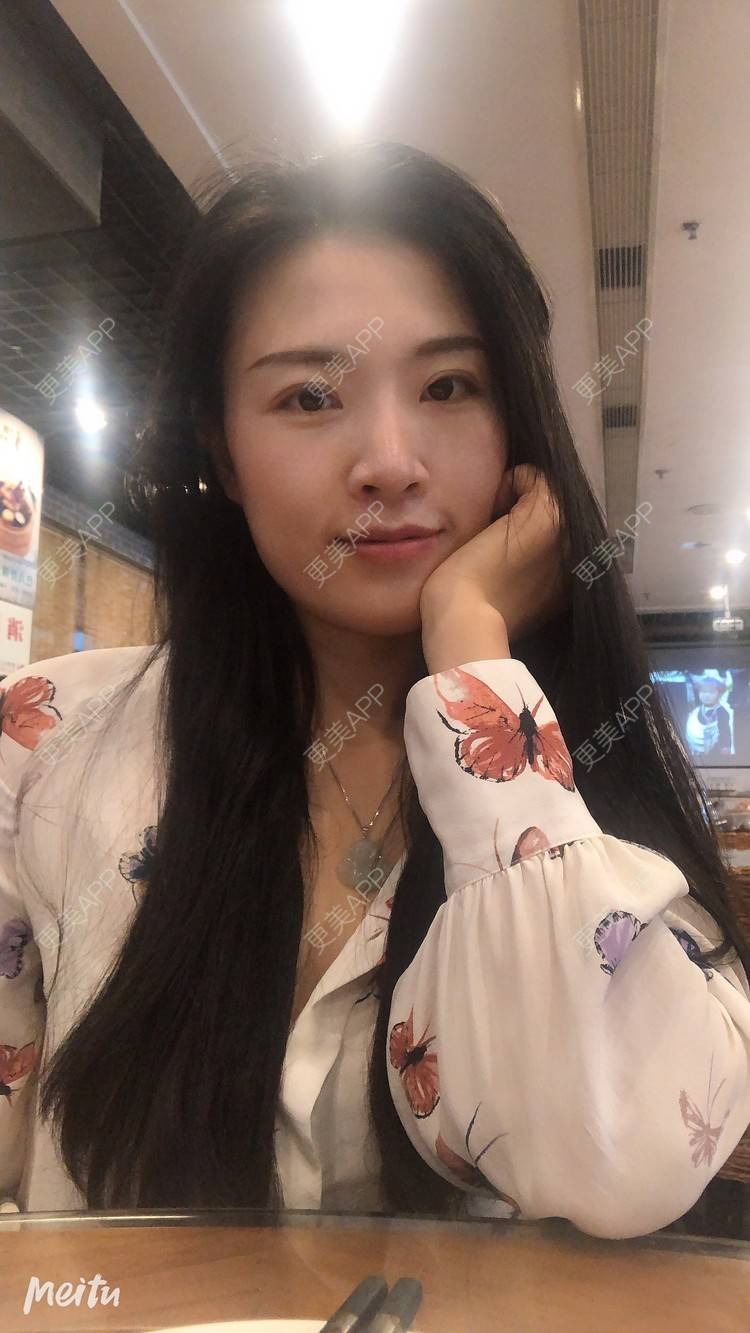 更美 - 更美用户M1Z1g3e73l的双下巴溶脂经验 | 双下巴溶脂