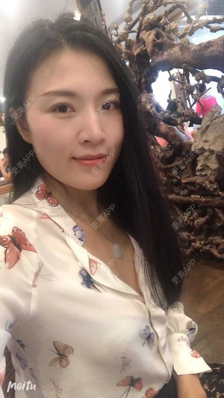 更美 - 更美用户M1Z1g3e73l的双下巴溶脂经验 | 双下巴溶脂