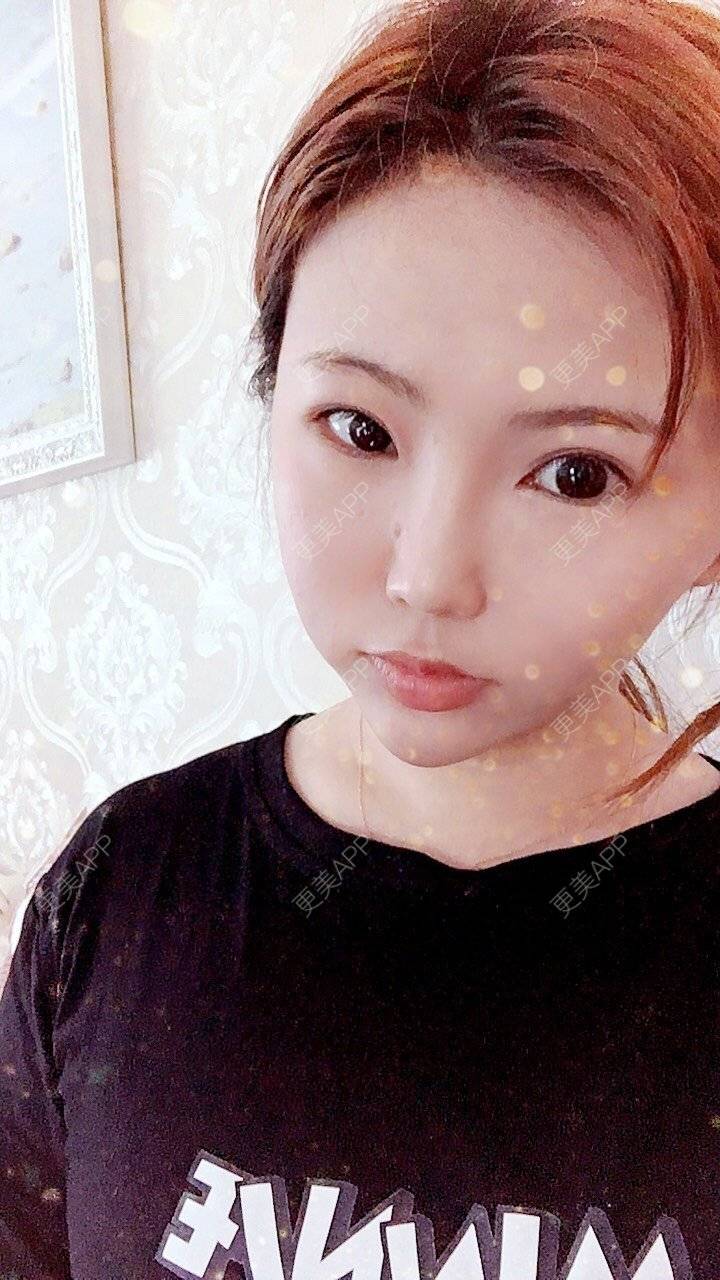 更美 - 家有宝兔的玻尿酸经验 | 玻尿酸套餐 | 上海 | 玻尿酸