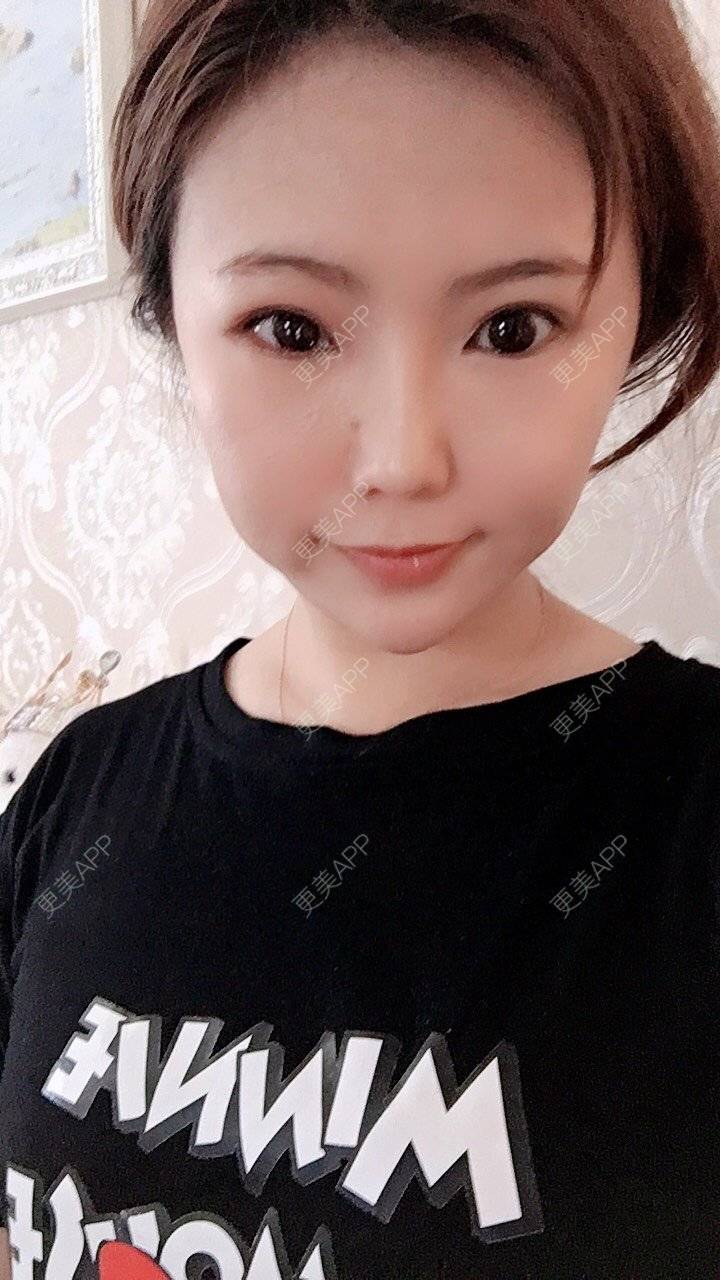 更美 - 家有宝兔的玻尿酸经验 | 玻尿酸套餐 | 上海 | 玻尿酸